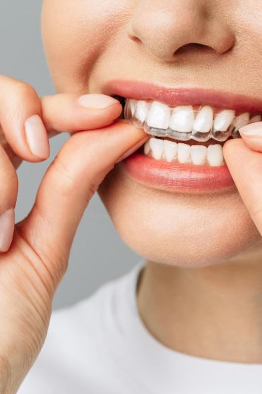 INVISALIGN2